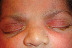 A child with eyelid imbrication.