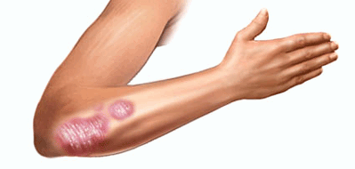 Skin illustration of psoriasis on an arm.