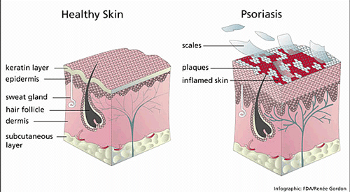 Skin illustration of healthy skin and psoriasis skin.