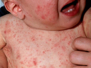 Scabies infecting the skin.
