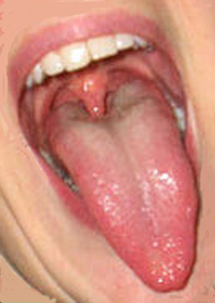 A duplicate of an actual photograph of the uvula in the mouth.